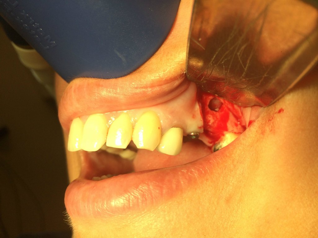 Sinus Lift