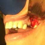 Sinus Lift
