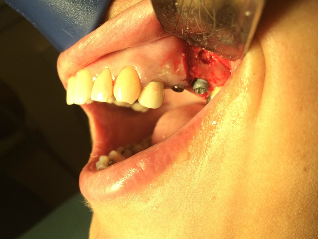 Sinus Lift