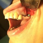 Sinus Lift