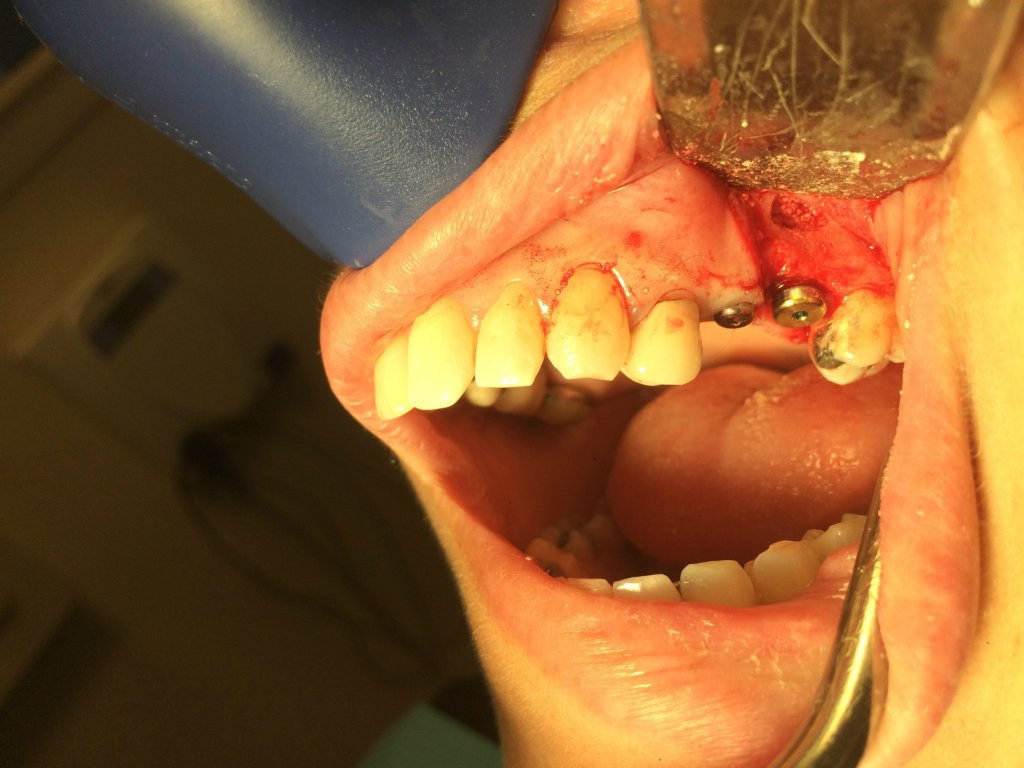 Sinus Lift