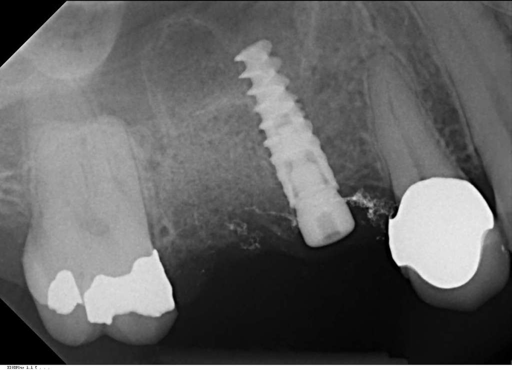 Sinus Lift