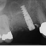 Sinus Lift