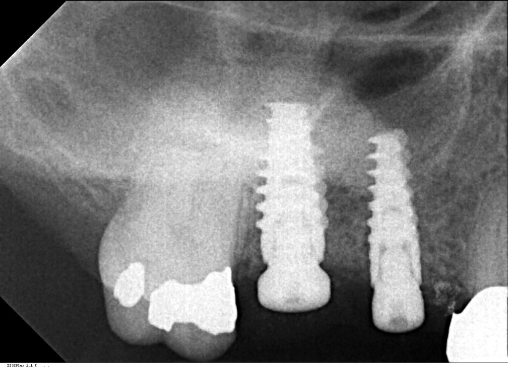Sinus Lift