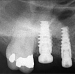 Sinus Lift