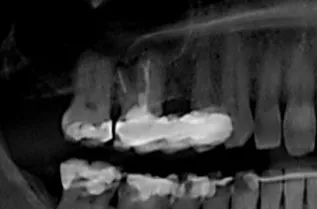 Sinus Lift